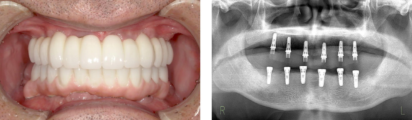 6本のインプラントを埋め込んだ状態