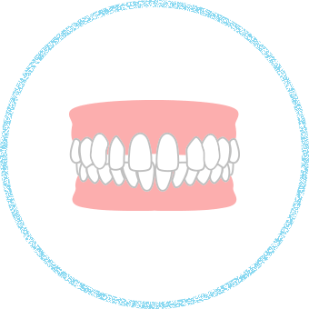 イラスト：空隙歯列