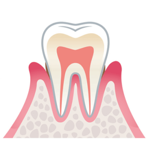 軽度な歯周病