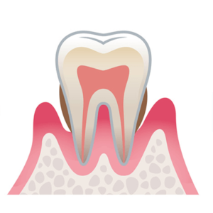 中等度な歯周病