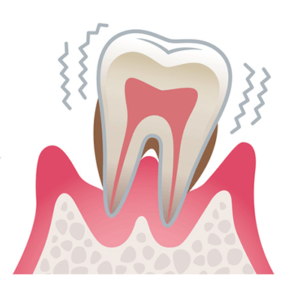 重度な歯周病